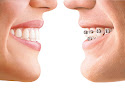 Teeth-in-Line Orthodontics