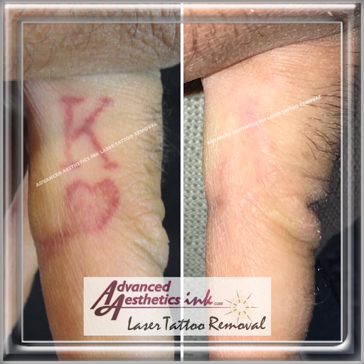 Explore finger tattoo ideas with meaning, creative tattoo ideas in South Dartmouth, available at Advanced Aesthetics Ink Laser Tattoo Removal
