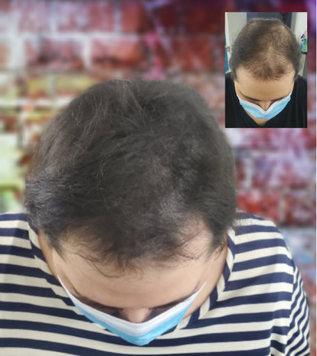 Downey Hair Loss Solutions SMP image