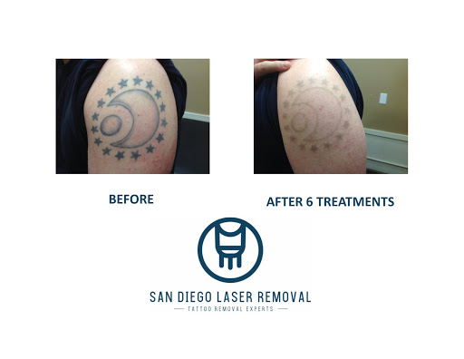 Explore perfectly imperfect tattoo ideas, creative tattoo ideas in San Diego, available at Removery Tattoo Removal & Fading