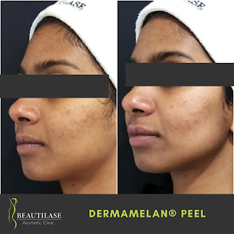 Beautilase - Beautilase