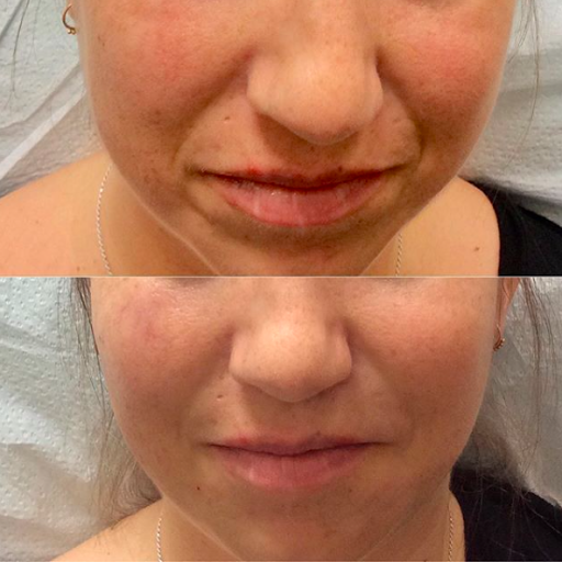 Explore chiefs tattoo ideas, creative tattoo ideas in Lake Oswego, available at Lake Oswego Vein and Aesthetic LOVA