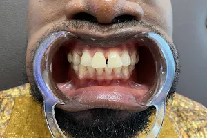 Mobile Laser Teeth Whitening Ghana image