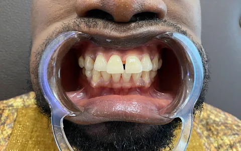 Mobile Laser Teeth Whitening Ghana image