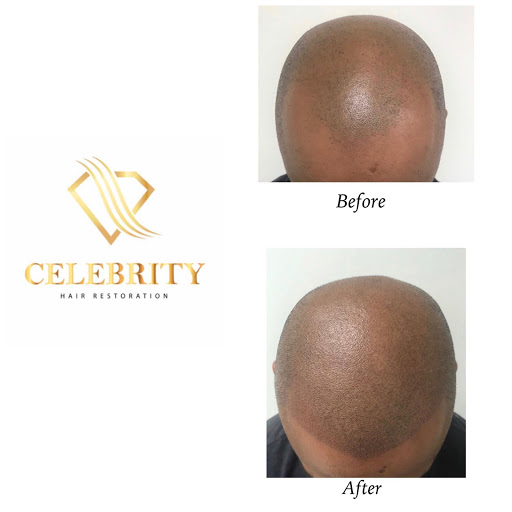 Celebrity Hair Restoration