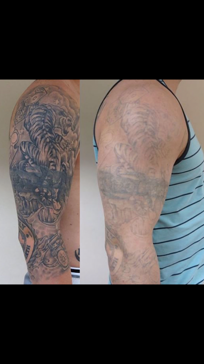 TATTOOFF İSTANBUL DÖVME SİLME HASTANESİ