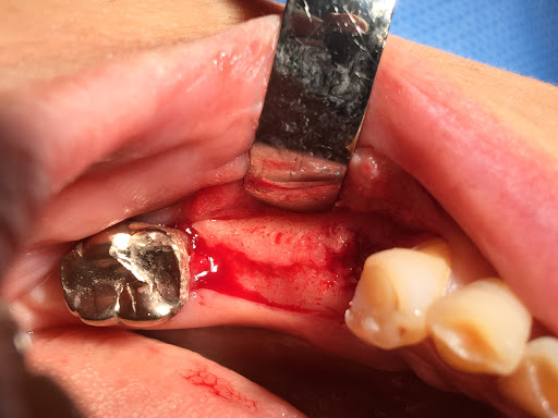 Los Angeles Endodontics and Implant