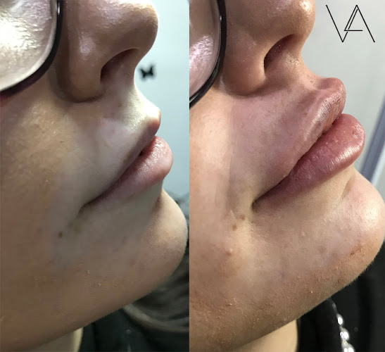 Comments and reviews of V&A Aesthetics - London Lip Fillers, Chin, Nose, Cheek & Jaw Filler Clinic