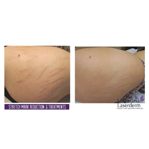 Explore silly goose tattoo ideas, creative tattoo ideas in Baton Rouge, available at Louisiana Laserderm