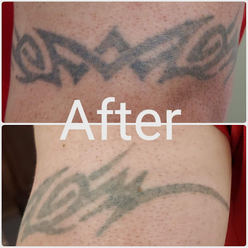 Explore cover up tattoo ideas female chest, creative tattoo ideas in Brighton, available at Tip of the Spear Laser Esthetics