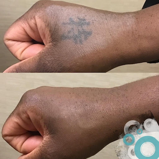 Explore cover up tattoo ideas for feet, creative tattoo ideas in Memphis, available at Removery Tattoo Removal & Fading
