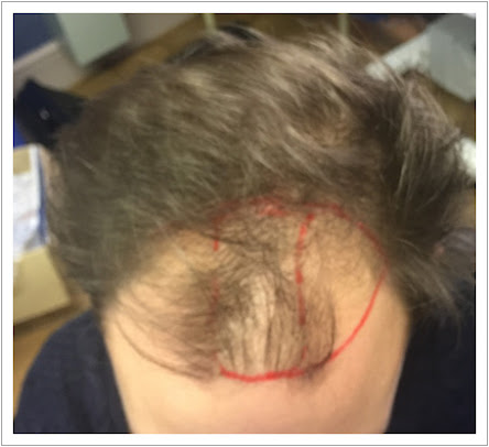 عيادات زراعة الشعر المملكة المتحدة بريستول - UK Hair Transplant Clinics Bristol