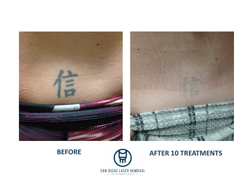 Explore neck tattoo ideas woman, creative tattoo ideas in San Diego, available at Removery Tattoo Removal & Fading