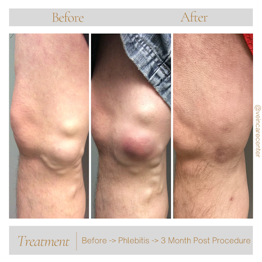 Explore good ideas for a cover up tattoo, creative tattoo ideas in Lima, available at Vein Care Center Laser Specialists