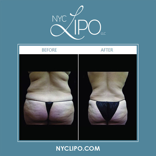 NYC Lipo LLC