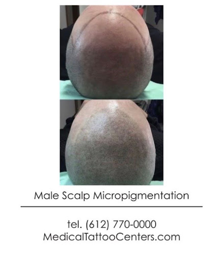 Explore tattoo ideas for the chest, creative tattoo ideas in Minneapolis, available at Medical Tattoo & Cosmetic Centers of America