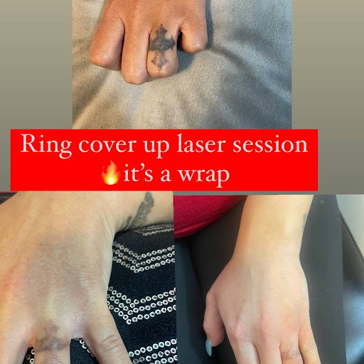 Explore wrist scar tattoo ideas, creative tattoo ideas in Dallas, available at Dtown Laser Tattoo Removal & Aesthetics,LLC