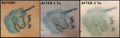 Explore tattoos cover up ideas, creative tattoo ideas in Vienna, available at Removery Tattoo Removal & Fading