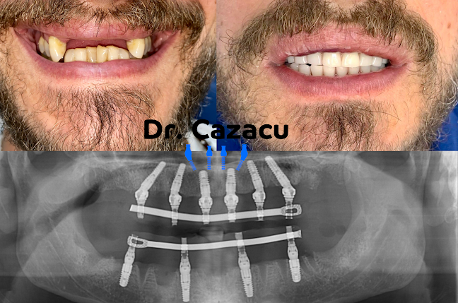 orar Dr. Cazacu Corrado Implant Dentar București Fast And Fixed Proteza Fixa Pe Implanturi