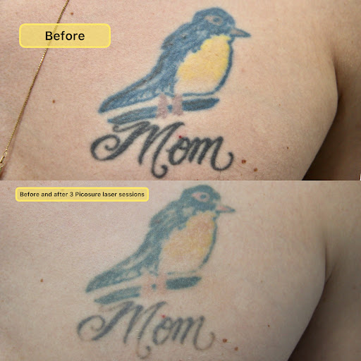 Explore aztec chest tattoo ideas, creative tattoo ideas in New York, available at Ag2g Laser Tattoo Removal & MedSpa