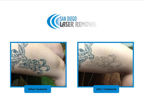Explore baseball tattoo ideas, creative tattoo ideas in San Diego, available at Removery Tattoo Removal & Fading