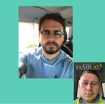 Better Hair Transplant Clinics - Nottingham - Better Hair Transplant Clinics - Nottingham