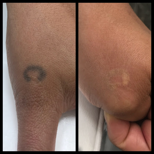 Explore infinity heart tattoo ideas, creative tattoo ideas in Middle Village, available at Bye Bye Ink Laser Tattoo Removal