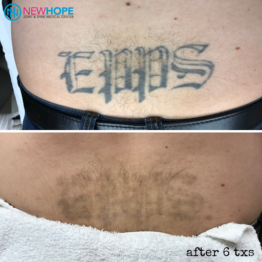 Explore the idea of you tattoos, creative tattoo ideas in Westminster, available at Newhope Laser Skin Care