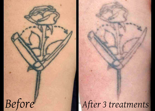 Explore iowa tattoo ideas, creative tattoo ideas in Brighton, available at Tip of the Spear Laser Esthetics