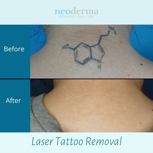 Explore palm tree tattoo ideas, creative tattoo ideas in Anaheim, available at Neoderma