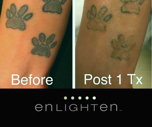 Explore lion cub tattoo ideas, creative tattoo ideas in Covington, available at Northshore Tattoo Removal