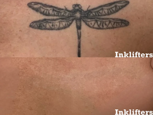 Explore beautiful crazy tattoo ideas, creative tattoo ideas in Pleasant Grove, available at Inklifters Tattoo Removal