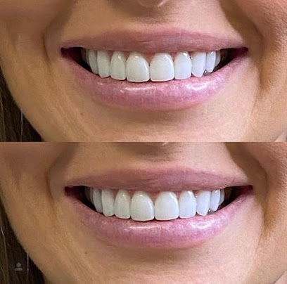 SmileOn Perth | Dental Veneers