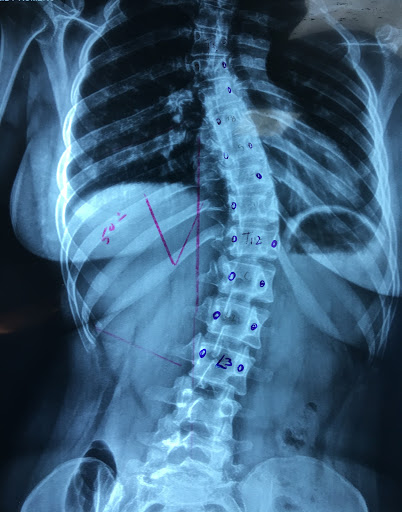 Unidad de Columna Vertebral Dr. Julio Angel García. Diagnóstico y Tratamiento. Centro Médico Dominicano