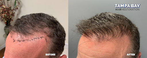 Hair Replacement Service «Tampa Bay Hair Restoration», reviews and photos, 1266 Turner St b, Clearwater, FL 33756, USA