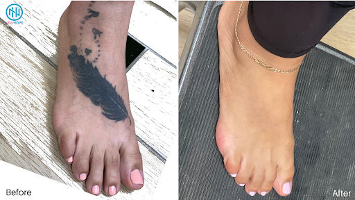 Explore $uicideboy$ tattoo ideas, creative tattoo ideas in Westminster, available at Newhope Laser Skin Care