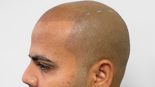 The Micro Fade - Orlando Scalp Micropigmentation Clinic