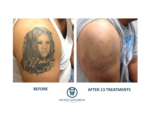 Explore mens tattoo cover up ideas, creative tattoo ideas in San Diego, available at Removery Tattoo Removal & Fading