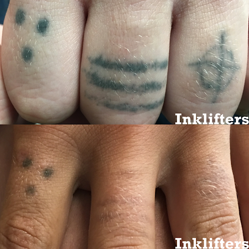 Explore finger cover up tattoo ideas, creative tattoo ideas in Pleasant Grove, available at Inklifters Tattoo Removal