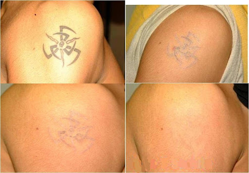 ZAP that TATT Laser Tattoo Removal Santa Clarita