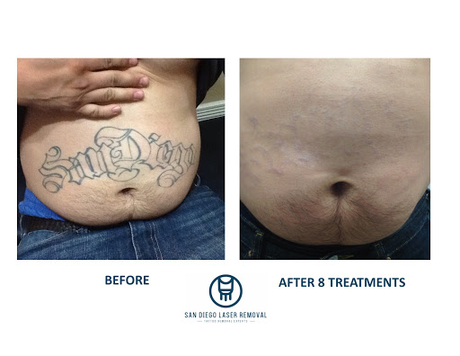 Explore apocalypse tattoo ideas, creative tattoo ideas in San Diego, available at Removery Tattoo Removal & Fading