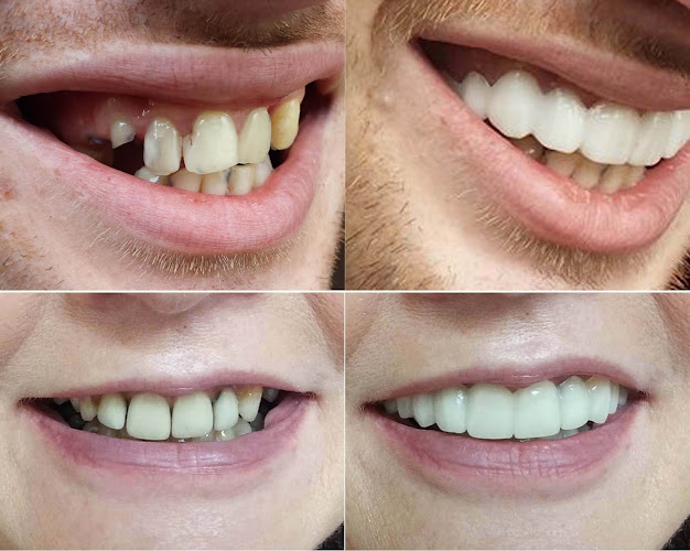 Denture Cosmetics + Instant White Smile