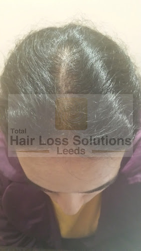 Total Hair Loss Solutions - Leeds
