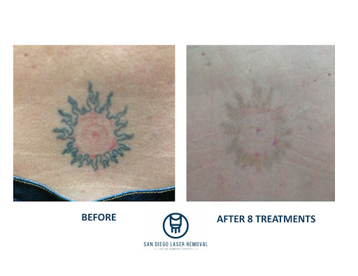 Explore no regrets tattoo ideas, creative tattoo ideas in San Diego, available at Removery Tattoo Removal & Fading