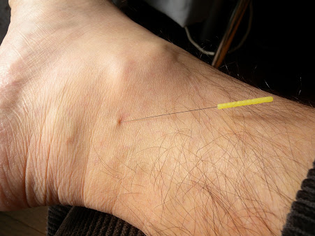 Thomas' Acupuncture Clinic - Thomas' Acupuncture Clinic