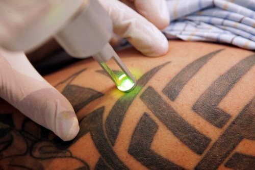 MEDermis Tattoo Removal