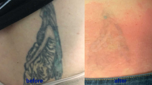 Explore cheek tattoo ideas, creative tattoo ideas in Sheffield Lake, available at TakeTatt Tattoo Removal