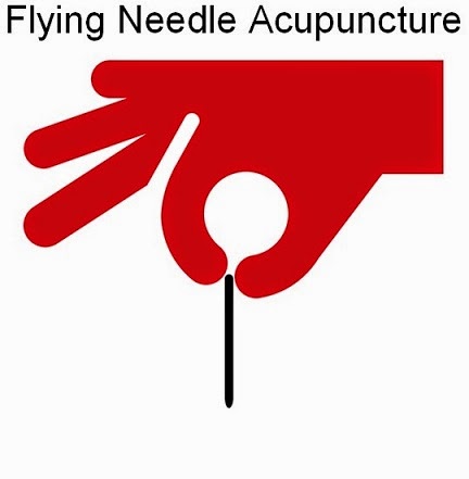 Flying Needle Acupuncture