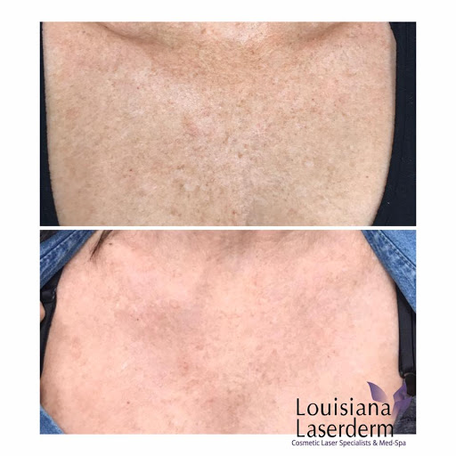 Explore kenny chesney tattoo ideas, creative tattoo ideas in Baton Rouge, available at Louisiana Laserderm