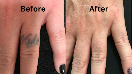 Explore painter tattoo ideas, creative tattoo ideas in Brookfield, available at Milwaukee Laser & Body Aesthetics